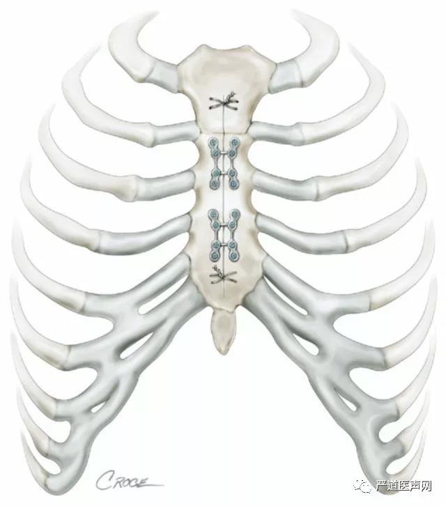 陆树洋:胸骨正中劈开术后如何复位固定胸骨才是最佳的?