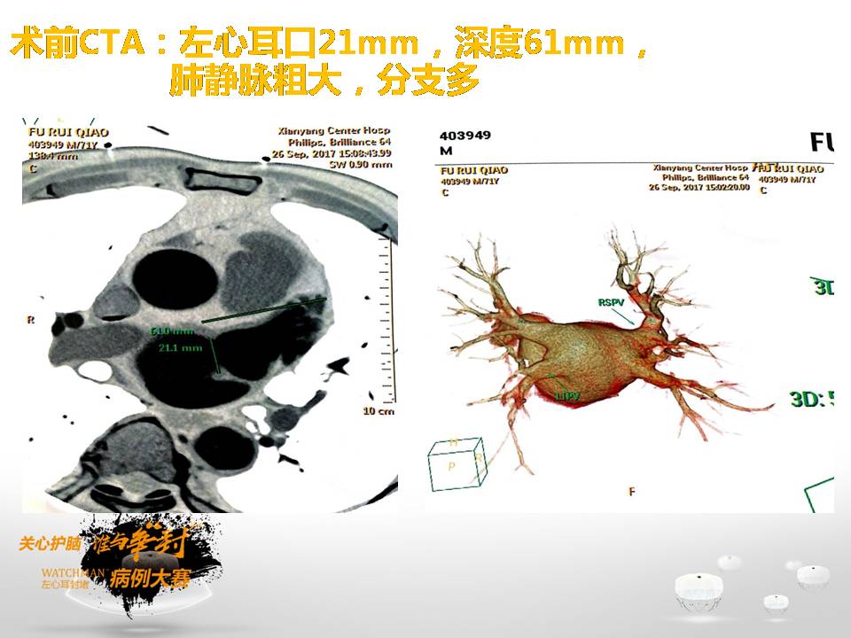 参赛病例|持续房颤合并左心耳血栓 抗栓后行房颤一站式手术