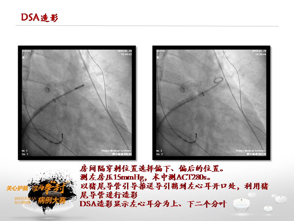 参赛病例|房间隔前置穿刺获得 左心耳封堵成功一例