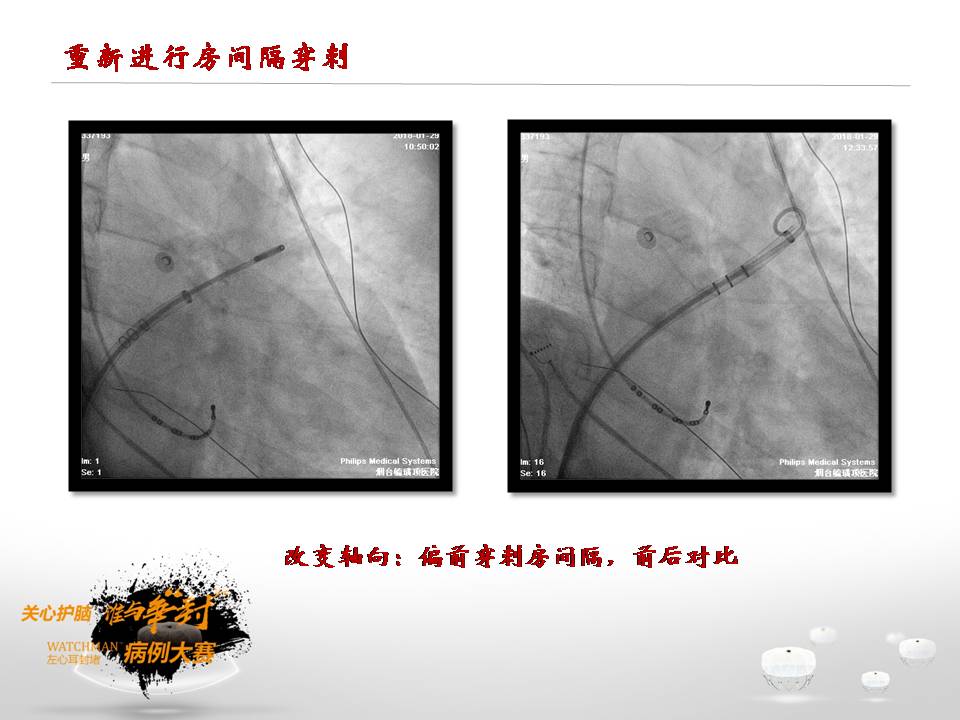 参赛病例|房间隔前置穿刺获得 左心耳封堵成功一例