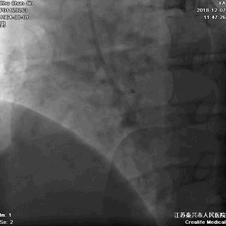 左冠无严重狭窄三,冠状动脉造影直接去导管室行冠状动脉造影:患者