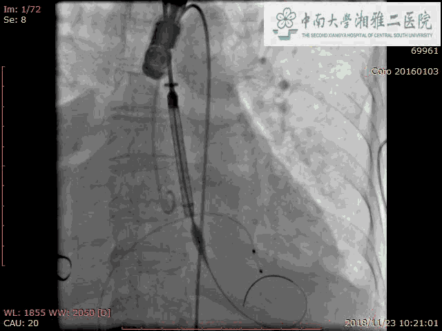 由于患者是type0二叶瓣,瓣膜形态欠佳,决定进行后扩;6,后扩后行造影