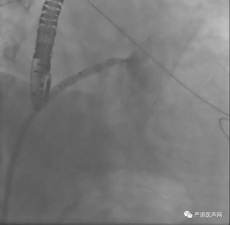 csi ap 2019 | live case:王建安教授团队成功演示watchman左心耳封堵