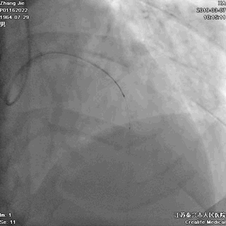 送人ivus导管,进行ivus检查