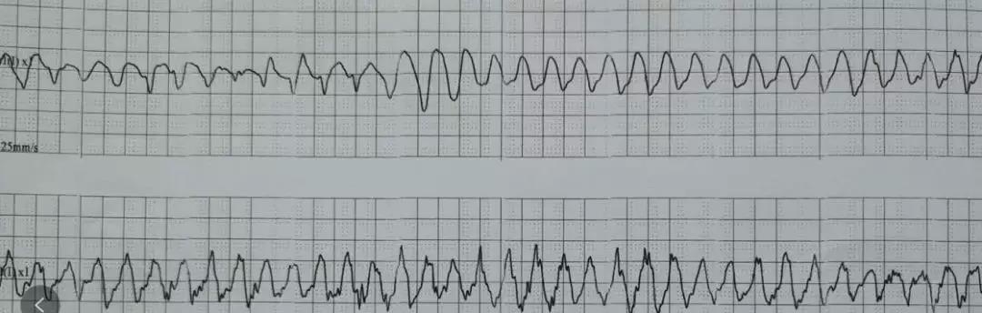 患者住院期间多次室颤
