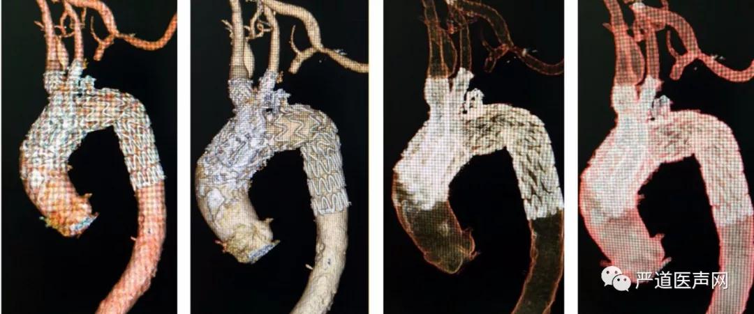 弓部动脉瘤被完全隔绝,主动脉主体和分支血管通畅,支架无i型和iii型内