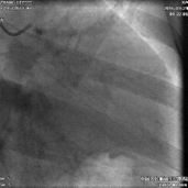lvef 54% 入院诊断:冠心病,不稳定心绞痛,陈旧下壁心肌梗死;2型糖尿病