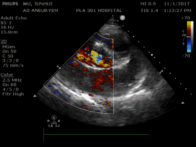 肺动脉瓣轻-中度反流左心扩大主动脉无冠窦破裂印象:肺动脉瓣轻-中度