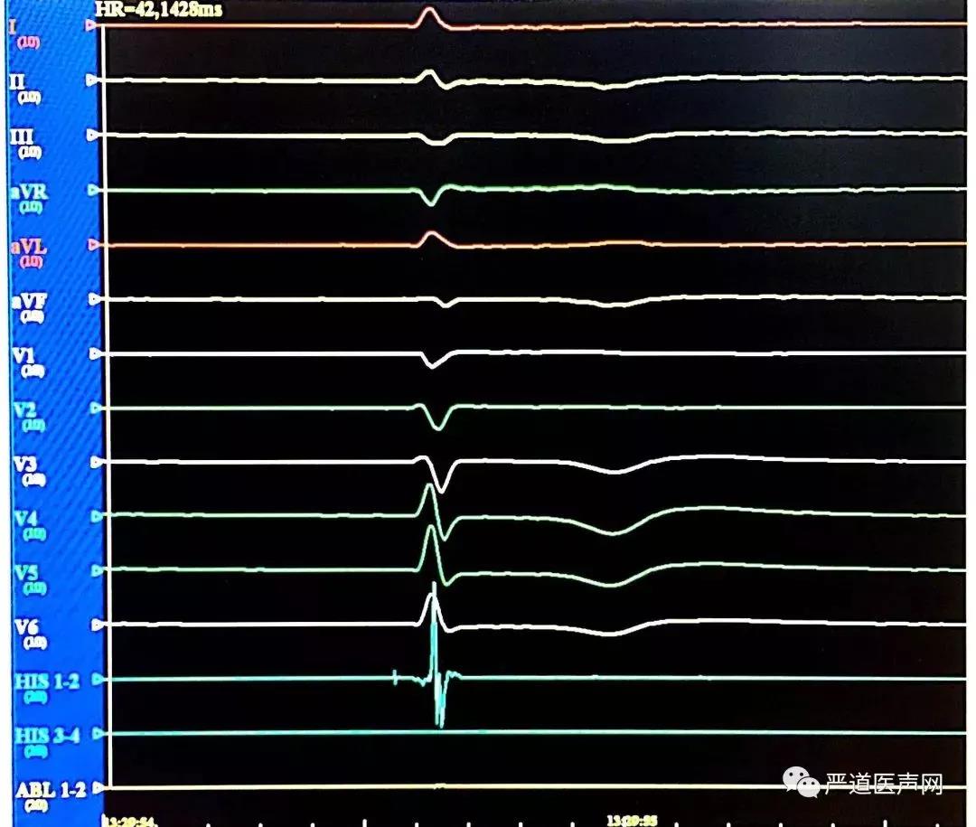 心功能iii级,crtd术后,电池耗竭病例2:正位影像rao影像laolbb起搏心电