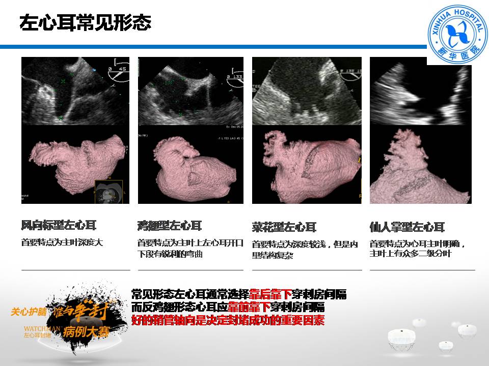 参赛病例|影像融合技术指导下 反弯鸡翅左心耳封堵病例