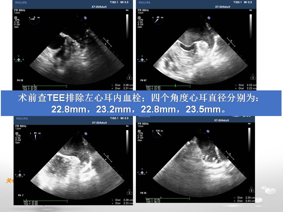 参赛病例|鸡翅型左心耳封堵术中血栓形成病例分享