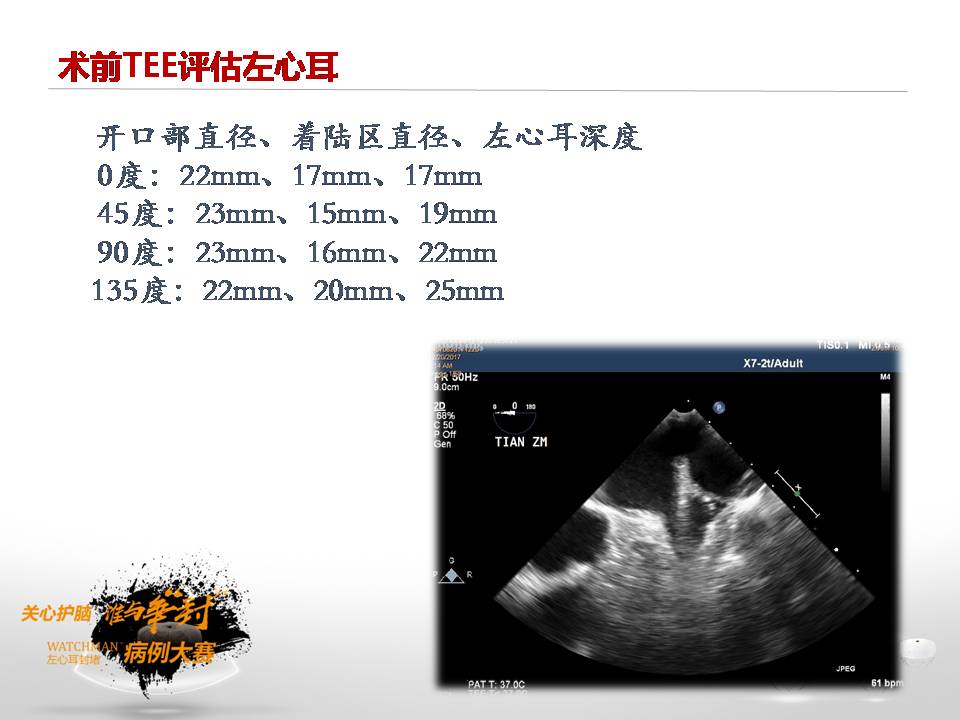 参赛病例|反鸡翅型左心耳病例
