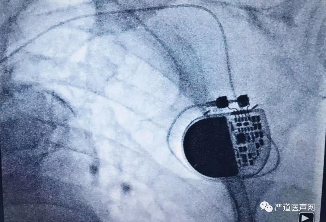 術中心臟起搏器x光影像
