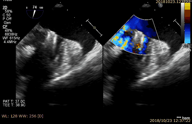 入院后行经胸心脏超声和经食道超声检查提示:la 42mm,lv 48mm,lvef 69