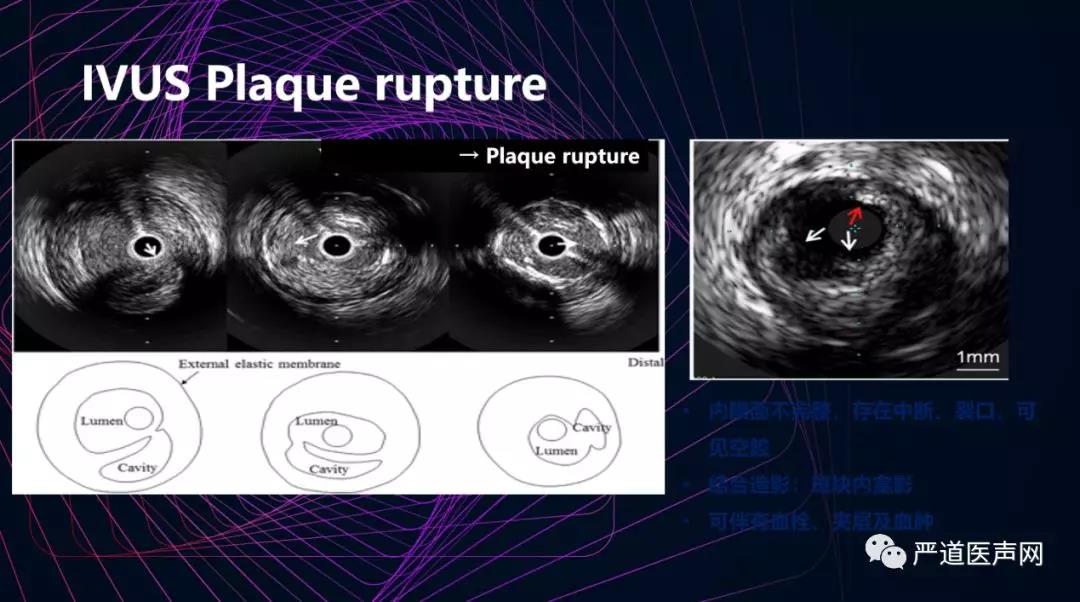 美国C3｜刘巍：IVUS的影像解读和测量 -- 严道脑血管网