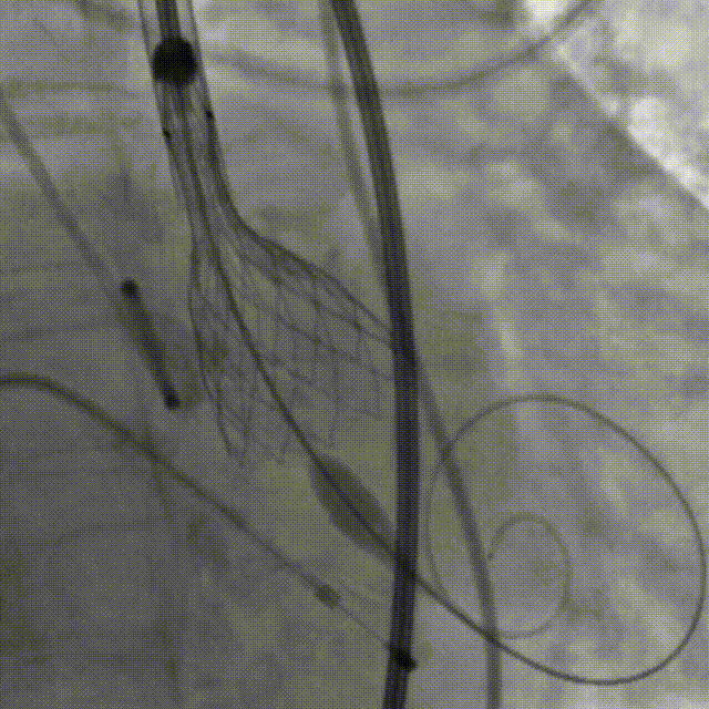 mm球囊),并优先准备av23的瓣膜装载(备av26瓣膜);由于股动脉入路情况