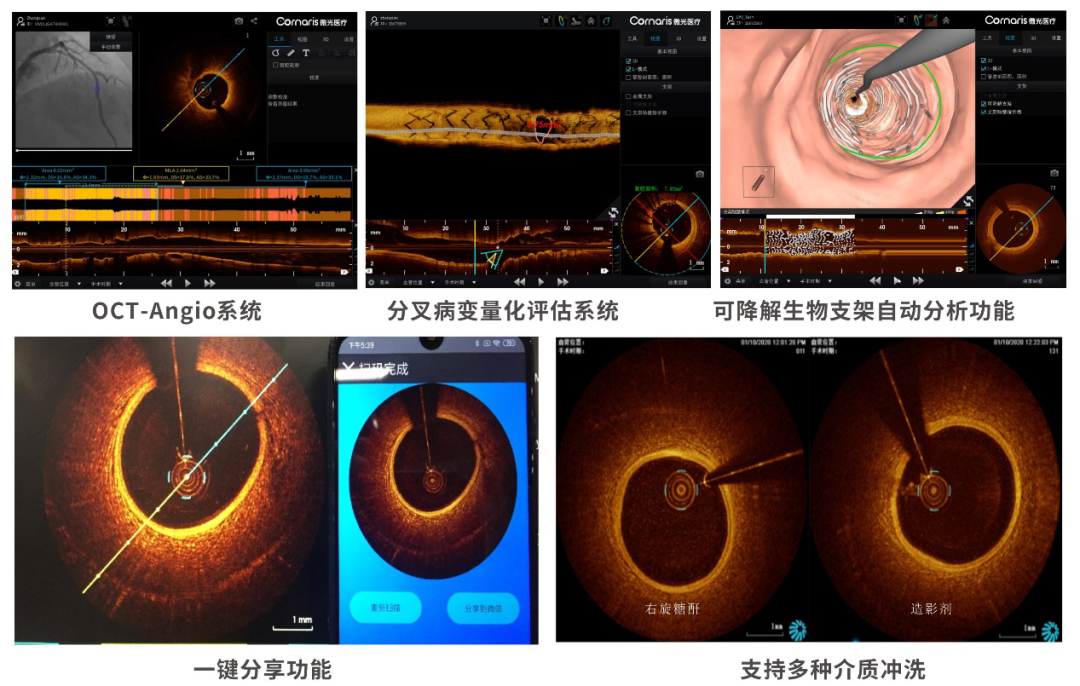 重磅|中国自主研发心血管oct系统正式上市 助力pci精准治疗