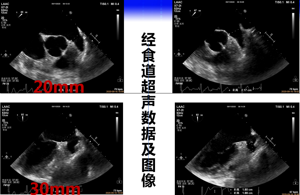 图5:tee测量固定盘着陆区尺寸20 mm,覆盖盘外口尺寸30 mm(盖式封堵伞