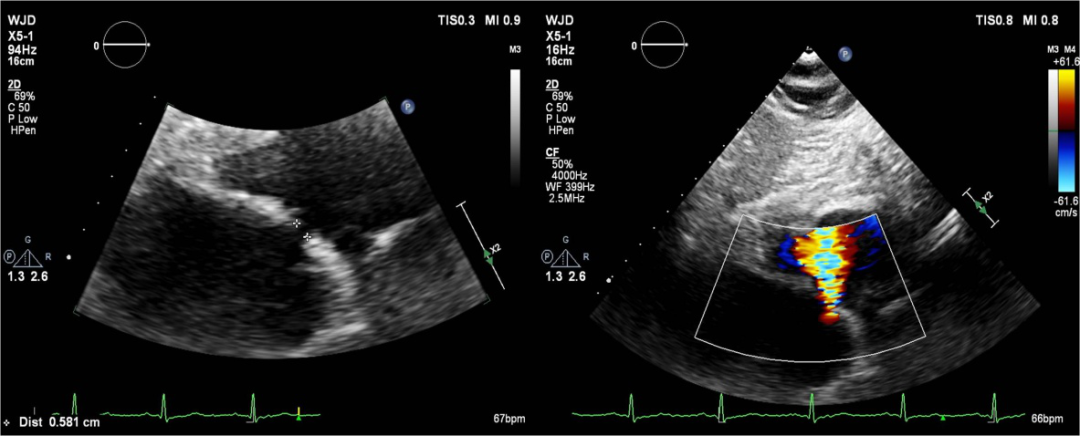 图解:超声心动图提示,术后通过所造房间隔瘘口,房水平可见左向右分流.