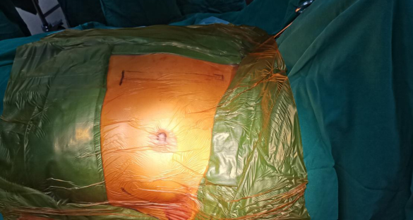 武汉亚洲心脏病医院湖北省首例全皮下植入式心律转复除颤器sicd成功