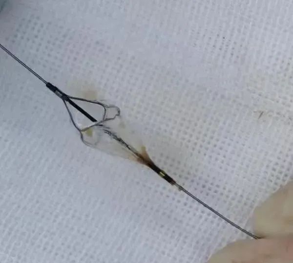 释放球囊预扩导丝跨瓣主动脉根部造影手术过程选用23mm球囊进行预扩张