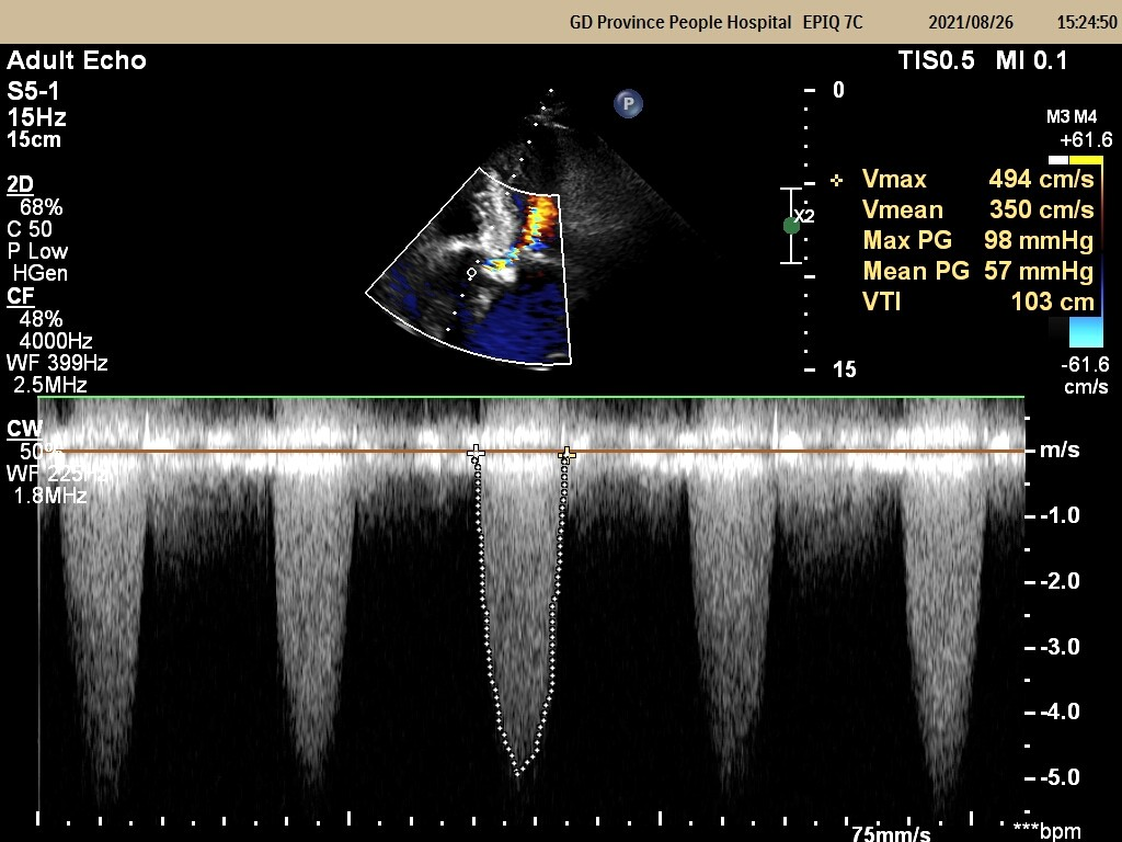 经典病例周周谈丨一例曲折的主动脉瓣狭窄合并血小板减少的tavr治疗